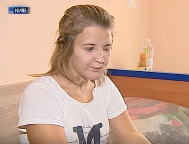 1,5 року рятують обличчя. Волинянці Іванці Гаджало зробили складну операцію