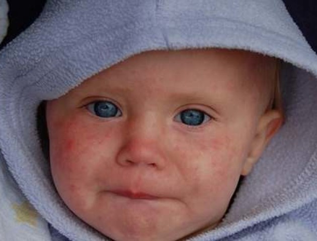На Волині на кір захворіло 5 дітей віком до одного року