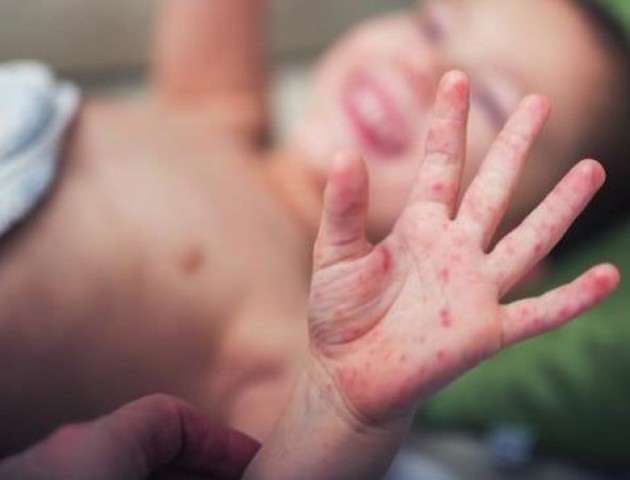 В яких школах Луцька гуляє кір