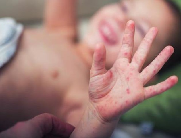 Назвали райони Волині, де найбільше і найменше хворіють на кір
