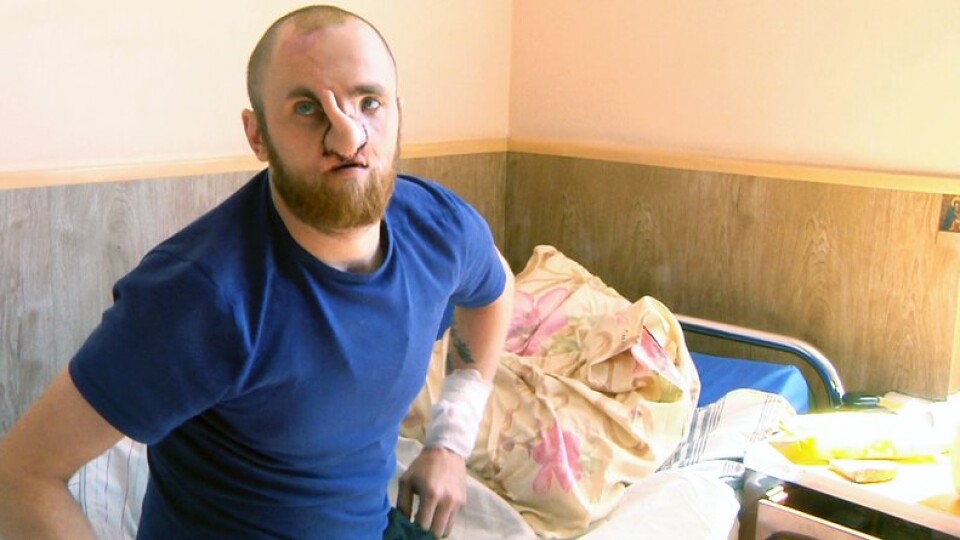 «І дихати можу, і запахи відчуваю»: на Волині хірурги відновлюють обличчя воїну