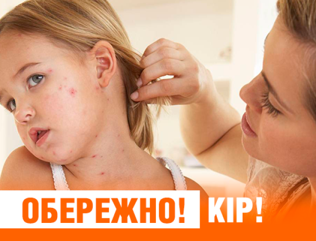 У Луцьку - епідемія кору